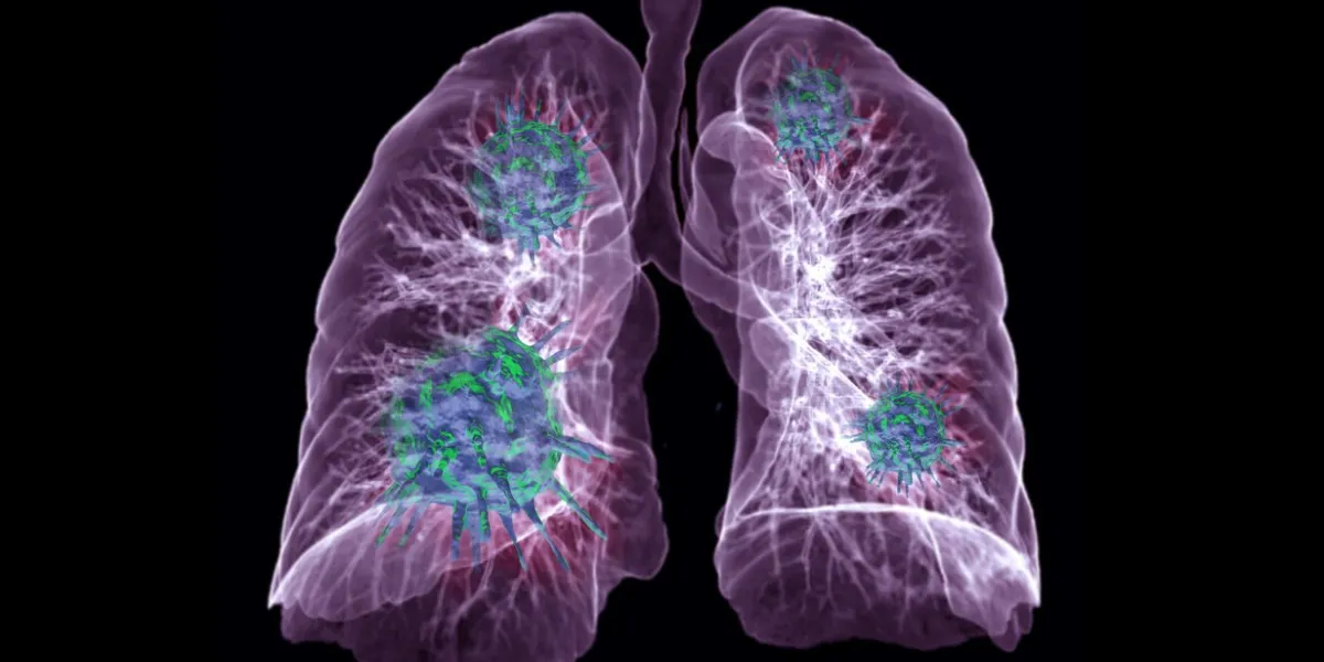 ct chest or lung 3d rendering image with virus 3d rendering on black background for diagnosis tb,tuberculosis and covid-19