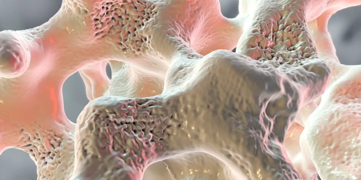 spongy bone tissue affected by osteoporosis, 3d illustration