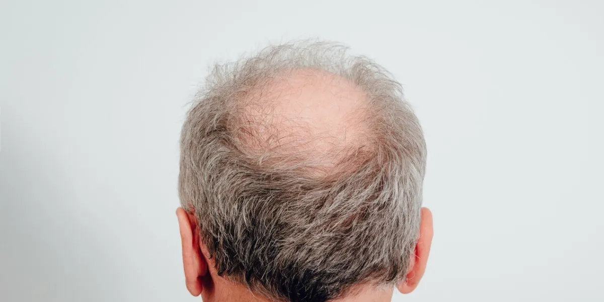 rear view of a male head without hair hair loss concept, bird's nest on the head