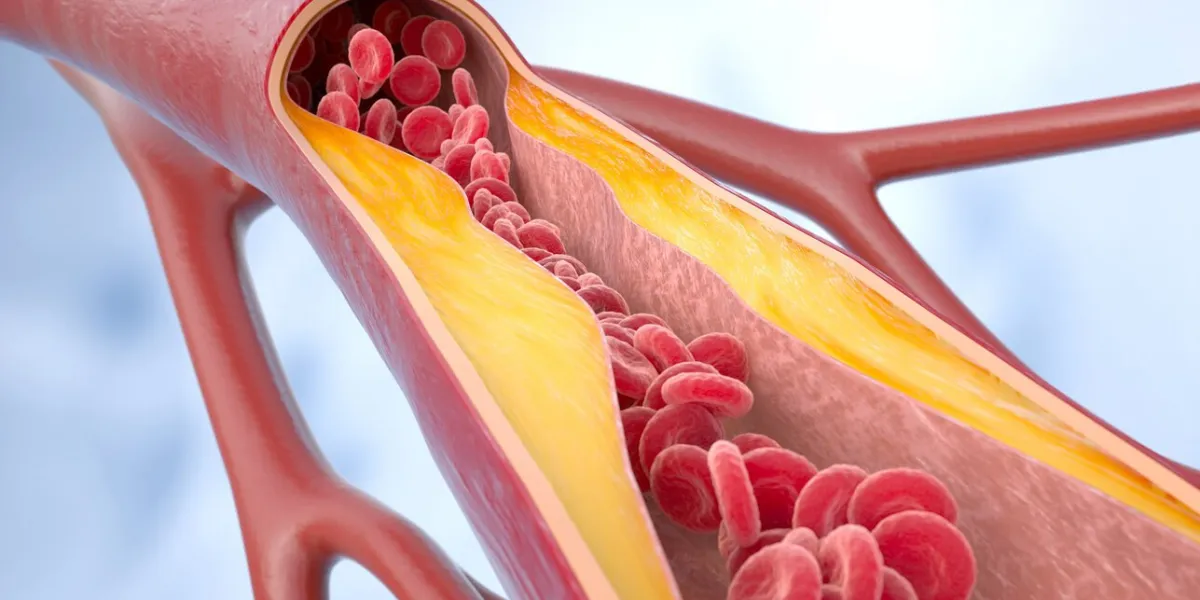 atherosclerosis disease cholesterol in the blood vessels atherosclerotic plaque, blood cells, blood pressure 3d rendering 3d illustration
