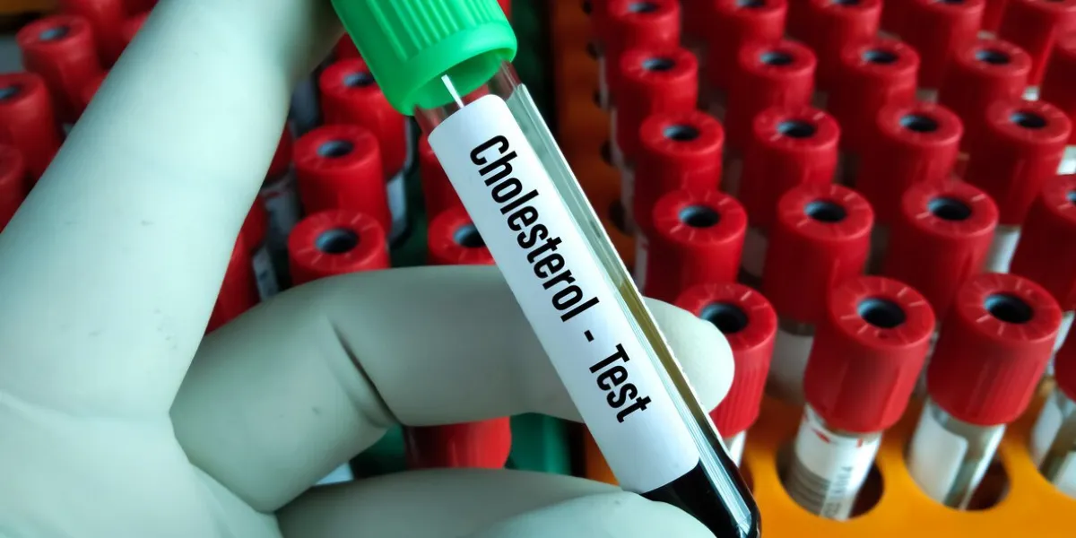 bloodblood sample tube for cholesterol test to diagnosis cardiac function at medical laboratory